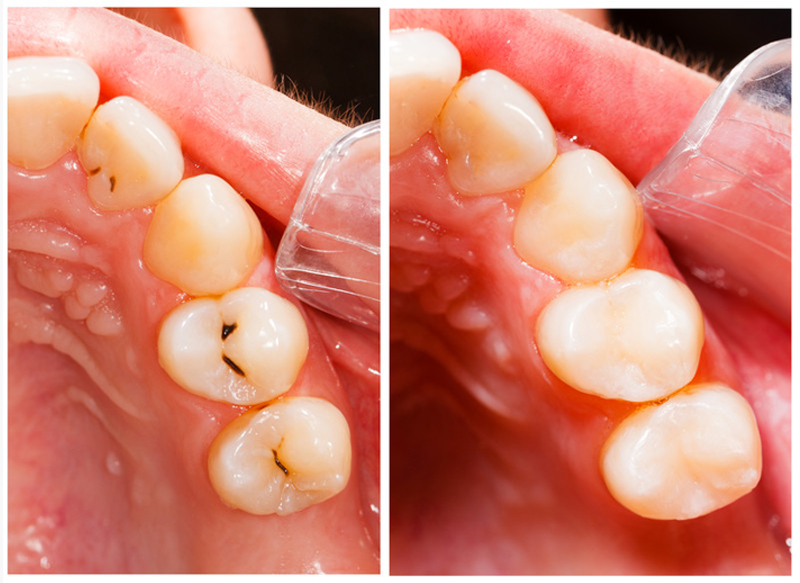 Fillings  Hamilton HM