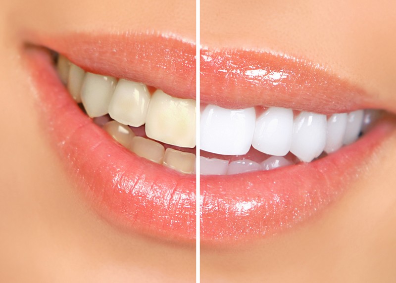 Teeth Whitening  Hamilton HM