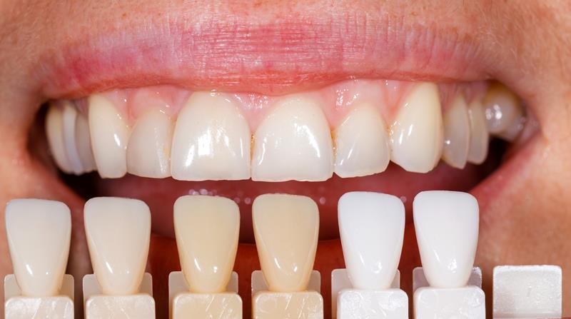 Veneers  Hamilton HM